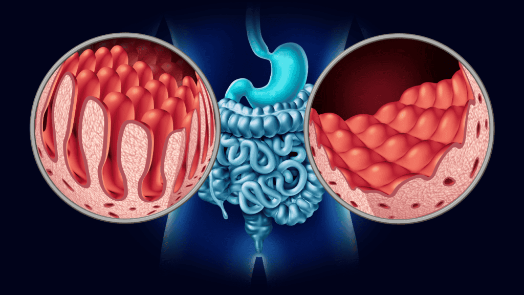 Celiac Disease vs. Gluten Sensitivity: Going Gluten-Free? | UFHC